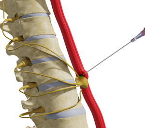 Celiac Plexus Block