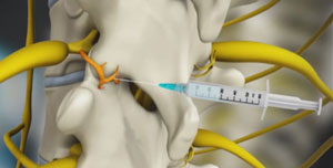 Cervical Medial Branch Block