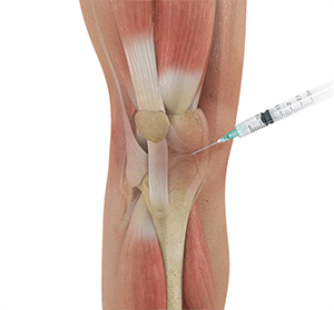 Knee Steroid Injection