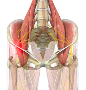 Meralgia Paresthetica