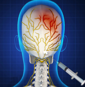 Occipital & Peripheral Nerve Blocks