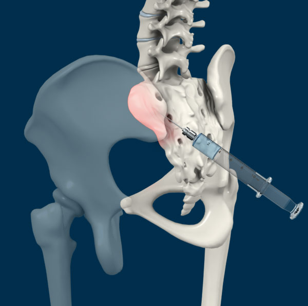 Peripheral Joint Injections