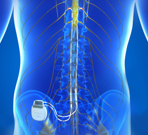 Peripheral Nerve Stimulation