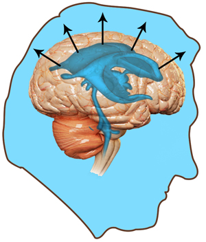 Pseudotumor Cerebri/Idiopathic Intracranial Hypertension