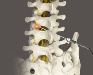 Radiofrequency Lesioning (RFL)