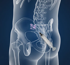 Sacroiliac Joint Injections