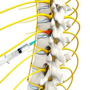 Selective Nerve Block