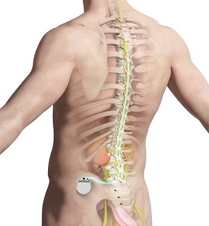 Spinal Cord Stimulators - Central Valley Pain Management