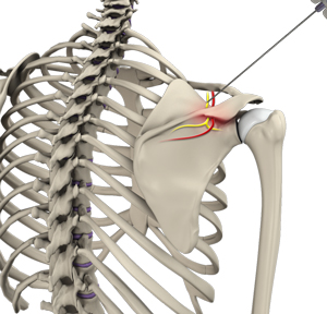 Suprascapular Nerve Block