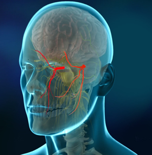 Trigeminal Neuralgia