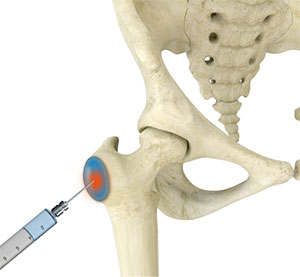 Trochanteric Bursa Injection