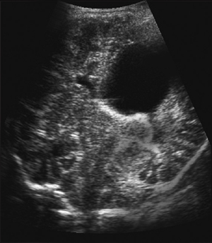 Ultrasound: Neurosonography